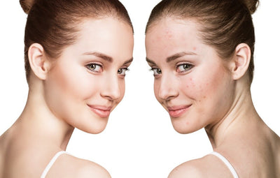 Makeup Tips and Guidelines For Acne-Prone Skin